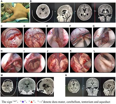 Optimal therapeutic strategies for pineal region lesions